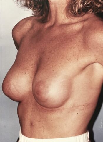 After Image: Breast Augmentation - left-front-oblique
