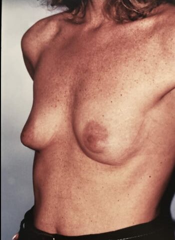 Before Image: Breast Augmentation - left-front-oblique