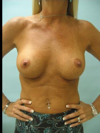 After Image: Breast Augmentation - front
