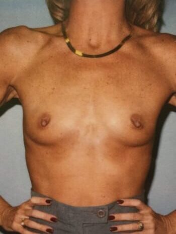 Before Image: Breast Augmentation - front