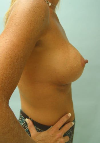 After Image: Breast Augmentation - right-side