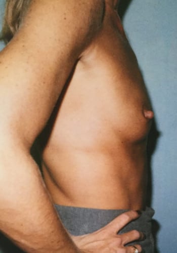 Before Image: Breast Augmentation - right-side