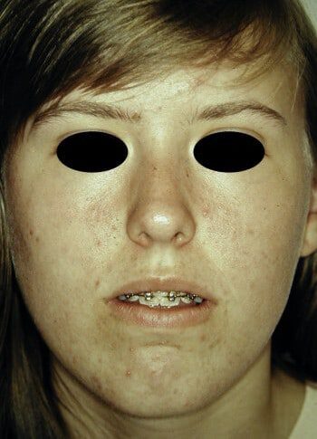 Before Image: Maxillofacial - back