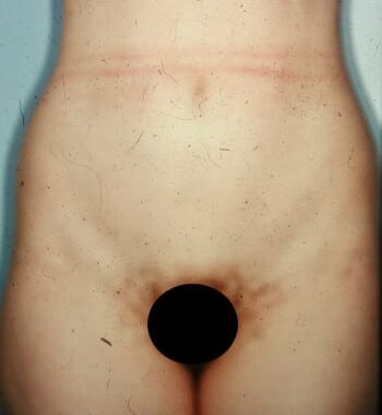 After Image: Abdominoplasty - front