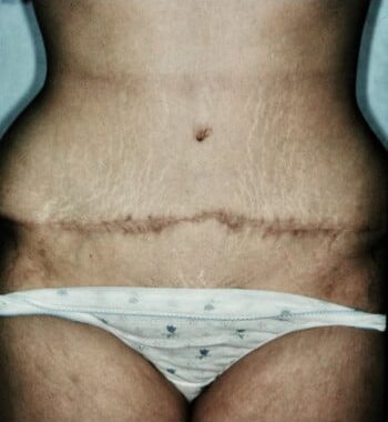 Before Image: Abdominoplasty - front