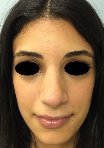 After Image: Rhinoplasty - front