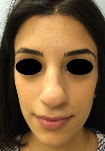 Before Image: Rhinoplasty - front