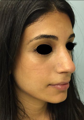 After Image: Rhinoplasty - right-front-oblique