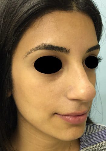 Before Image: Rhinoplasty - right-front-oblique