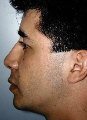 After Image: Genioplasty - left-side