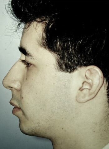 Before Image: Genioplasty - left-side