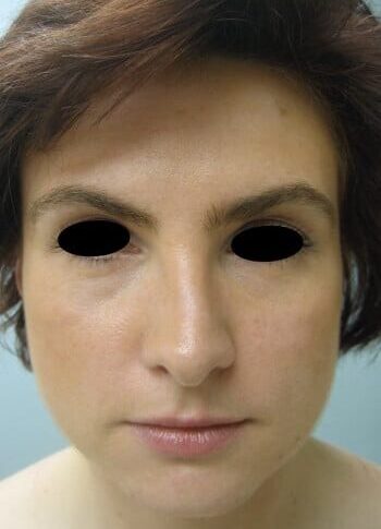 After Image: Rhinoplasty - front