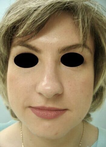 Before Image: Rhinoplasty - front