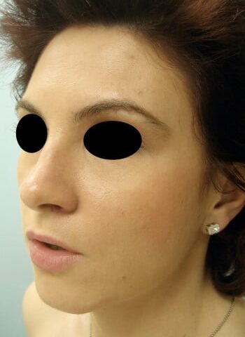After Image: Rhinoplasty - left-front-oblique