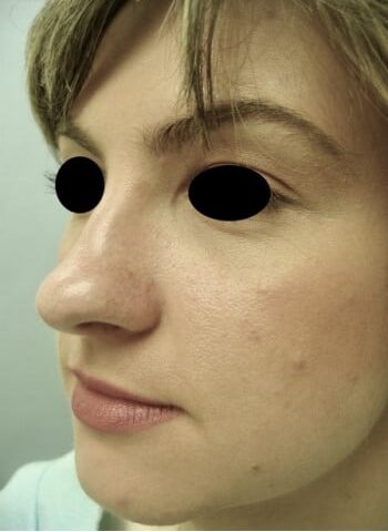 Before Image: Rhinoplasty - left-front-oblique