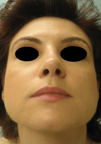 After Image: Rhinoplasty - front