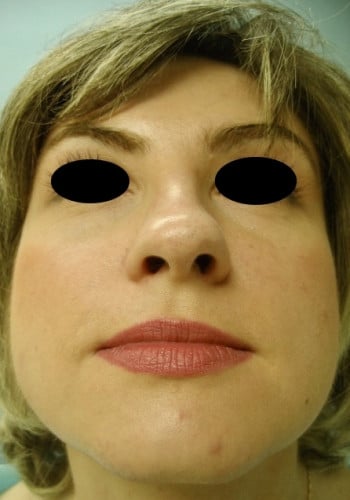 Before Image: Rhinoplasty - front