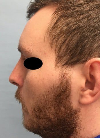 After Image: Rhinoplasty - left-side