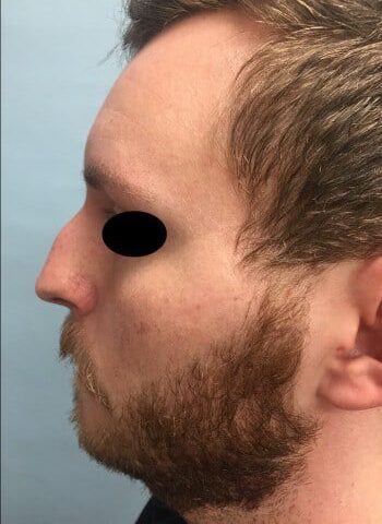 Before Image: Rhinoplasty - left-side