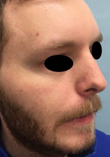 After Image: Rhinoplasty - right-front-oblique