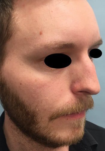 Before Image: Rhinoplasty - right-front-oblique