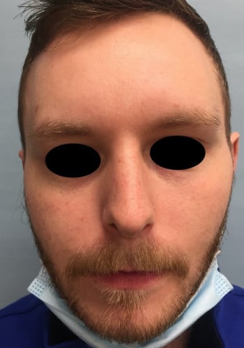 After Image: Rhinoplasty - front