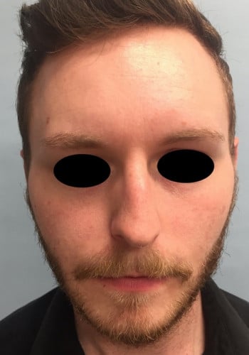 Before Image: Rhinoplasty - front