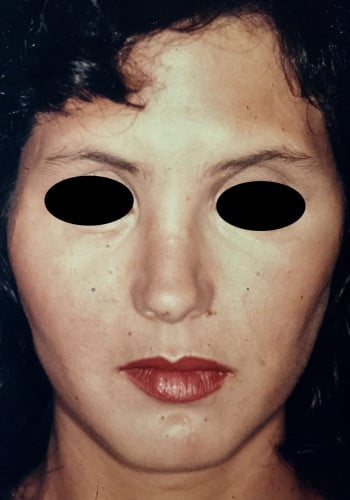 After Image: Maxillofacial - front
