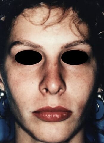 After Image: Rhinoplasty - front