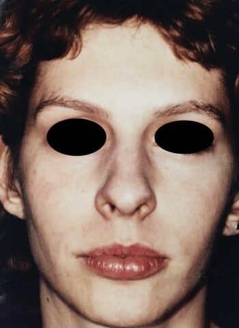 Before Image: Rhinoplasty - front