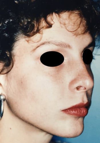 After Image: Rhinoplasty - right-front-oblique