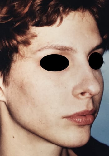 Before Image: Rhinoplasty - right-front-oblique