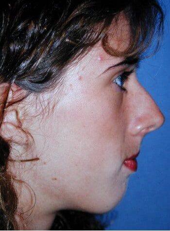 Before Image: Maxillofacial - right-side