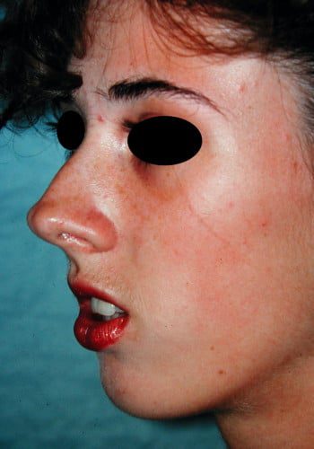 Before Image: Maxillofacial - left-front-oblique