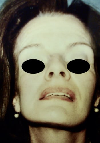 Before Image: Maxillofacial - front