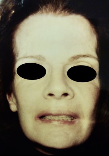 After Image: Maxillofacial - front