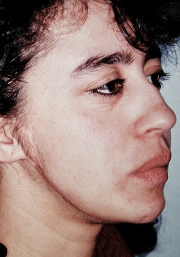 After Image: Facial Bone Augmentation - right-front-oblique