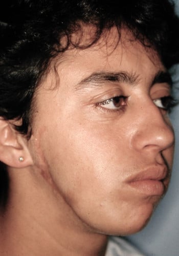 Before Image: Facial Bone Augmentation - right-front-oblique