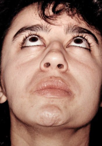 After Image: Facial Bone Augmentation - front