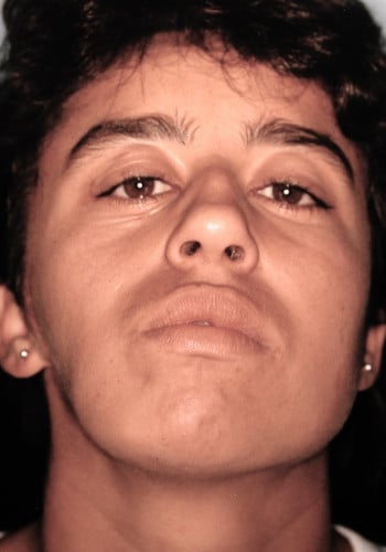 Before Image: Facial Bone Augmentation - front