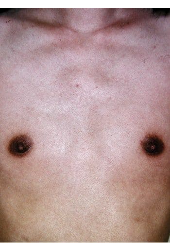 Before Image: Breast Augmentation - front
