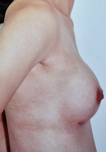 After Image: Breast Augmentation - right-side