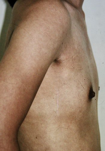 Before Image: Breast Augmentation - right-side