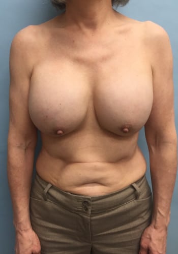 Before Image: Breast Revision - front