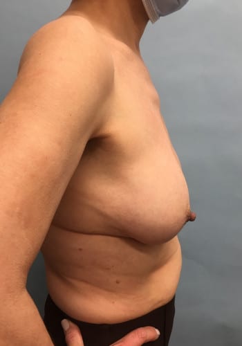 After Image: Breast Revision - right-side