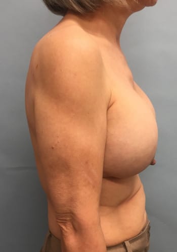Before Image: Breast Revision - right-side