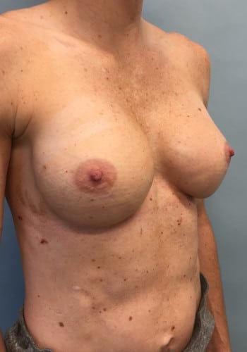 Before Image: Breast Revision - right-front-oblique