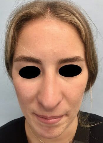 After Image: Rhinoplasty - front
