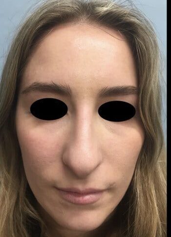 Before Image: Rhinoplasty - front
