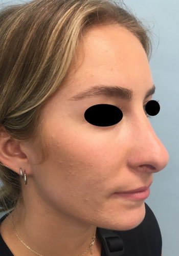 After Image: Rhinoplasty - right-front-oblique